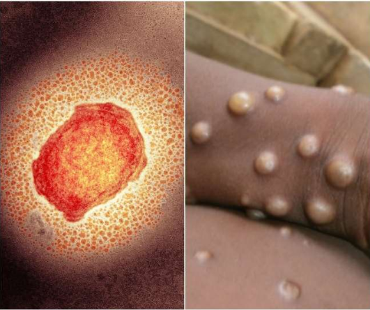 Monkeypox: Fever, rashes and pain are the symptoms of monkeypox, learn how to save yourself?